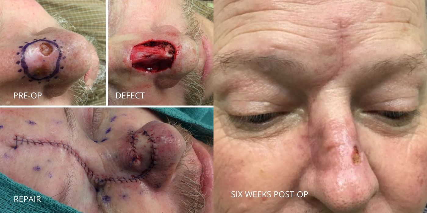 Mohs Surgery - Nose - Case 5406