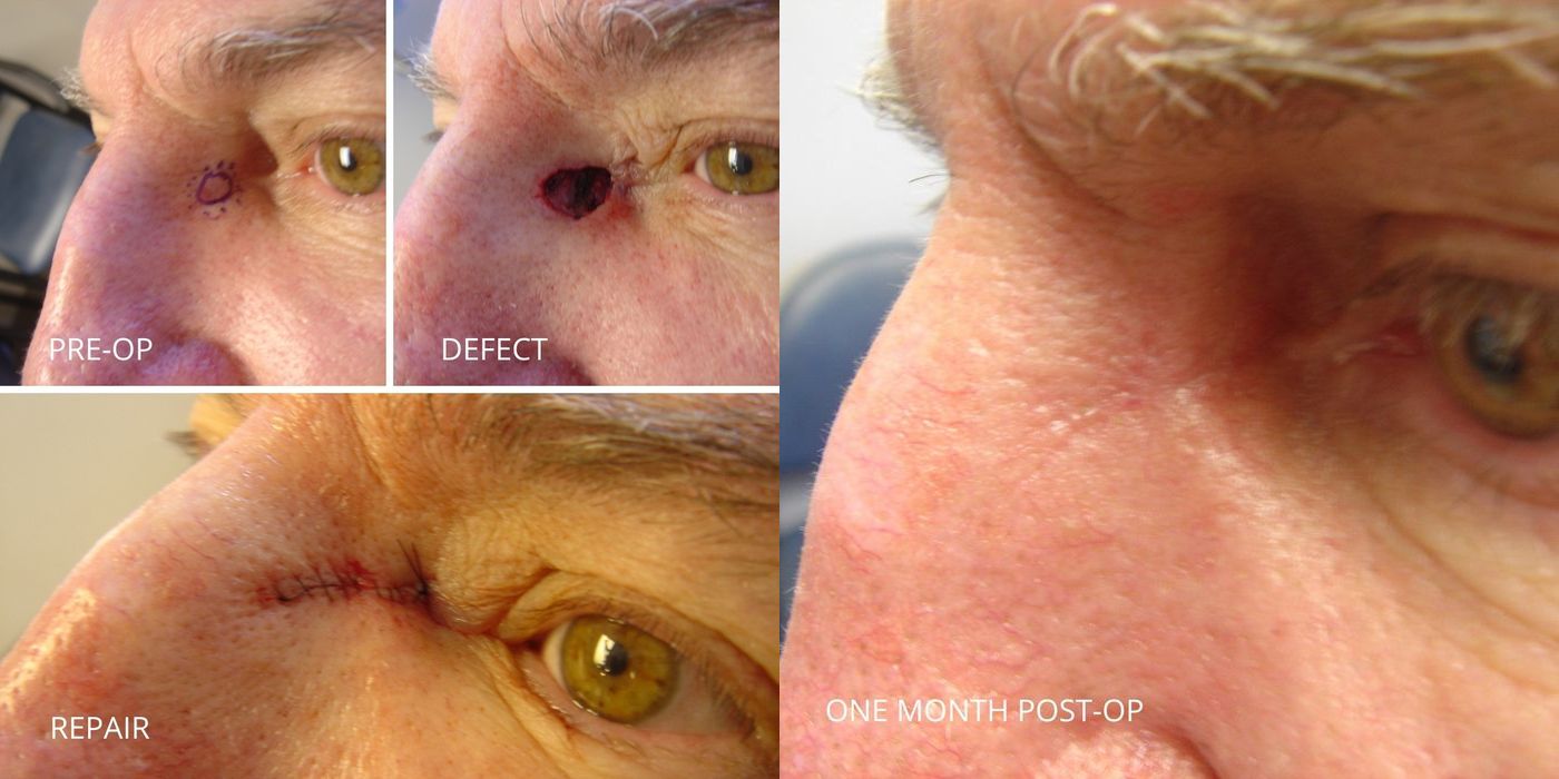 Mohs Surgery - Nose - Case 5390