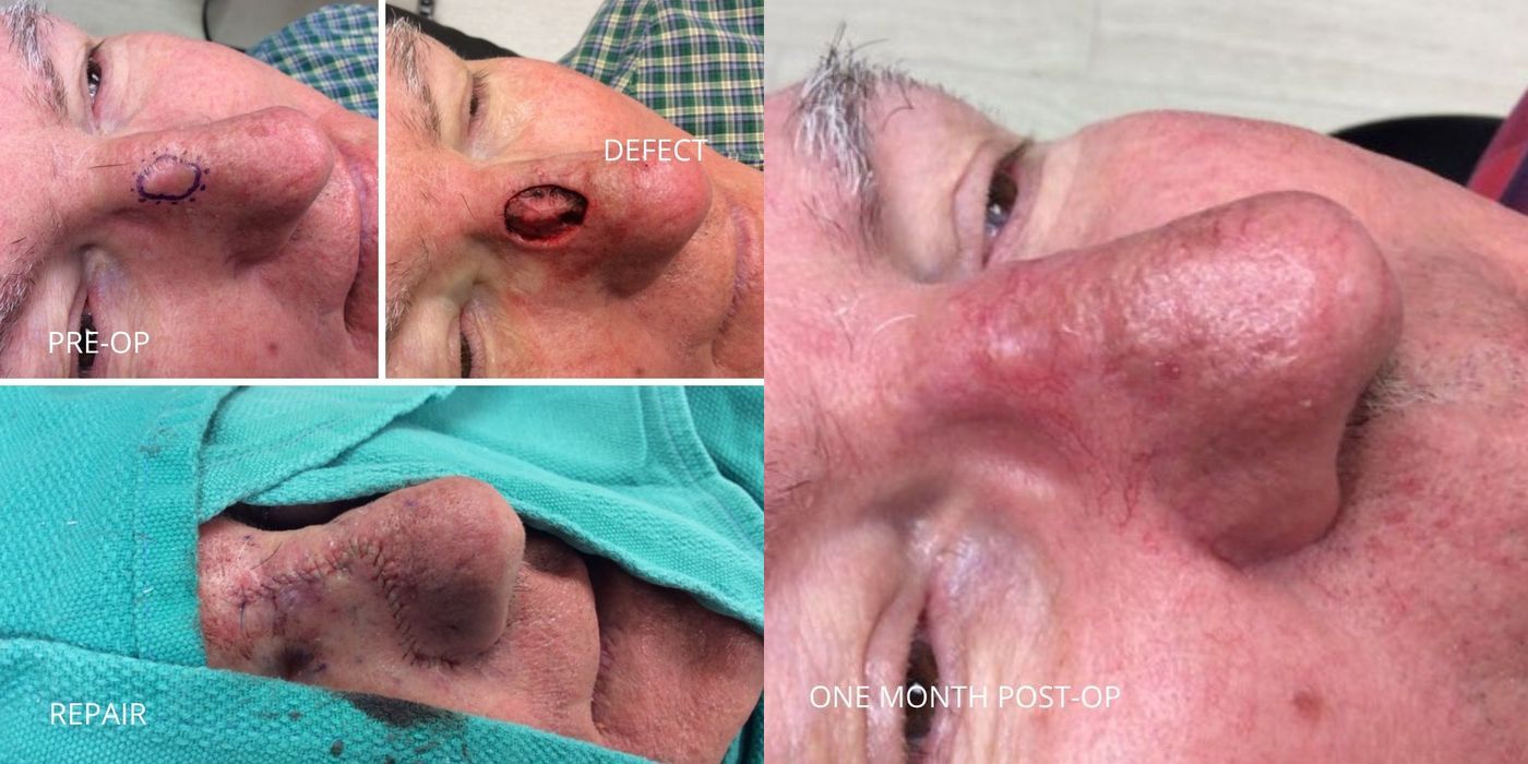 Mohs Surgery - Nose - Case 5394