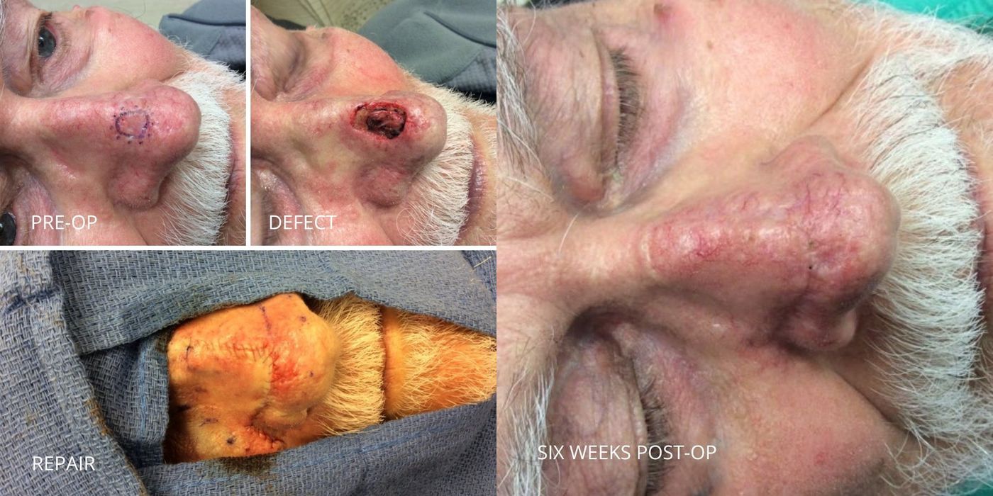 Mohs Surgery - Nose - Case 5404