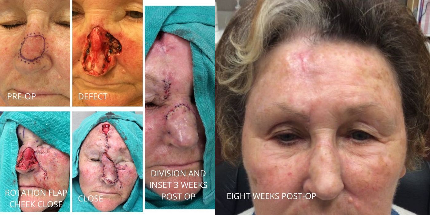 Mohs Surgery - Nose - Case 5403