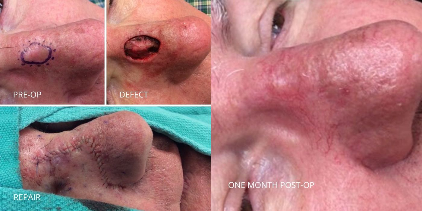 Mohs Surgery - Nose - Case 5388