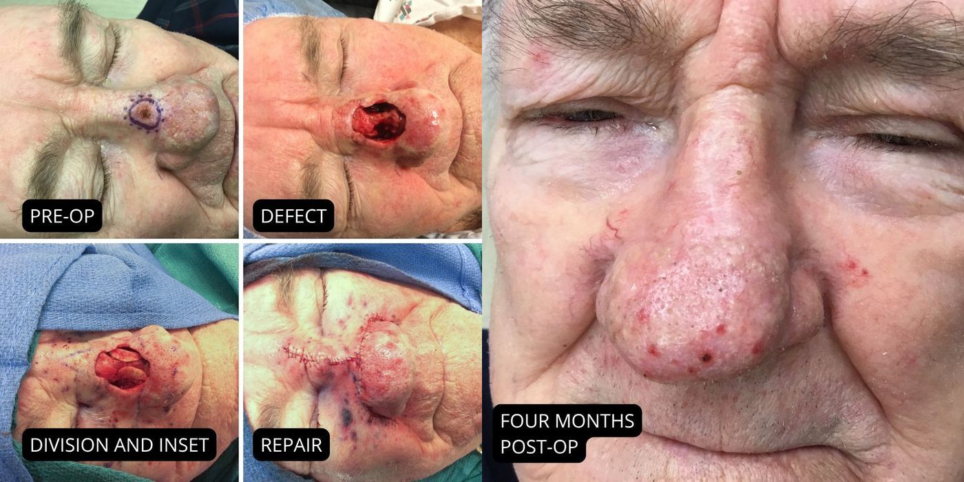 Mohs Surgery - Nose - Case 5407