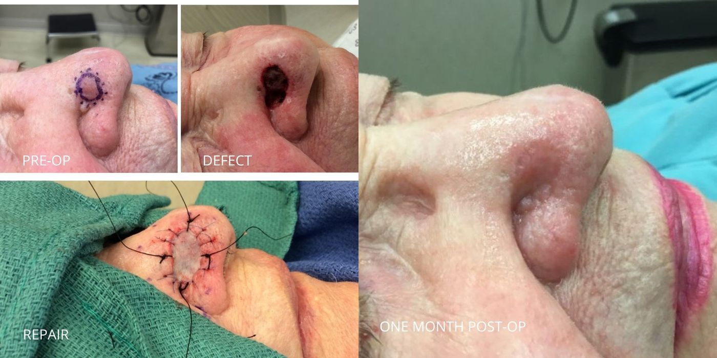 Mohs Surgery - Nose - Case 5392