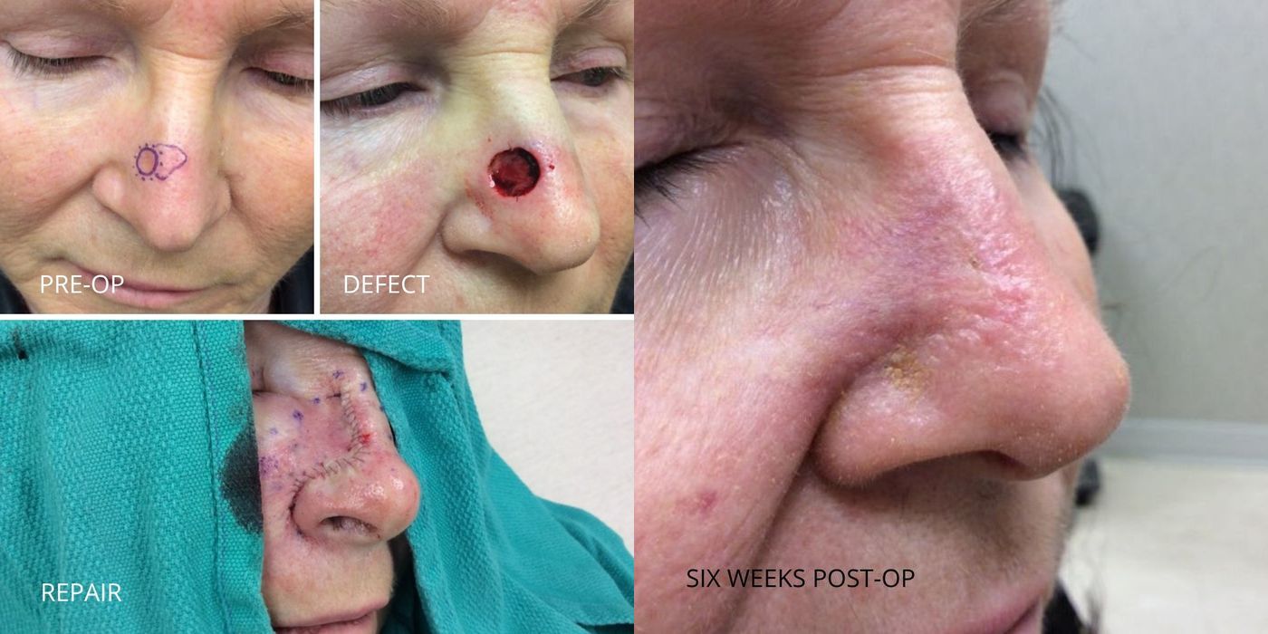 Mohs Surgery - Nose - Case 5399