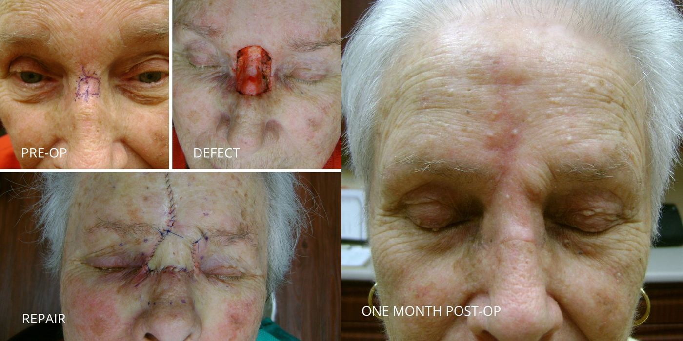 Mohs Surgery - Nose - Case 5391