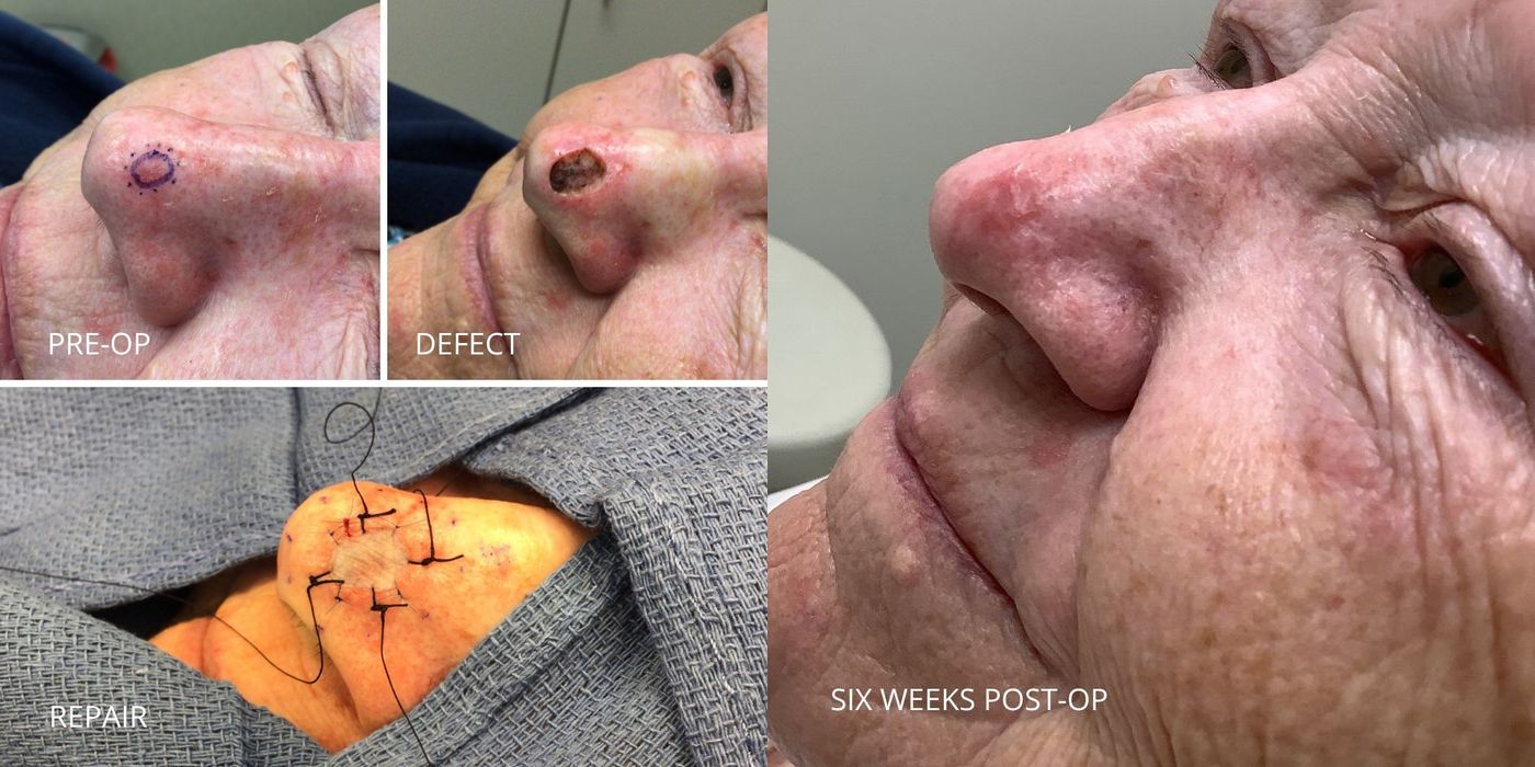 Mohs Surgery - Nose - Case 5395