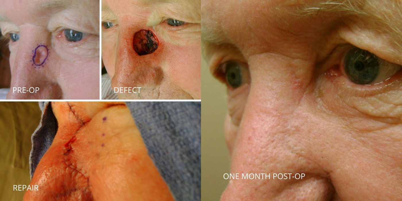 Mohs Surgery - Nose - Case 5387
