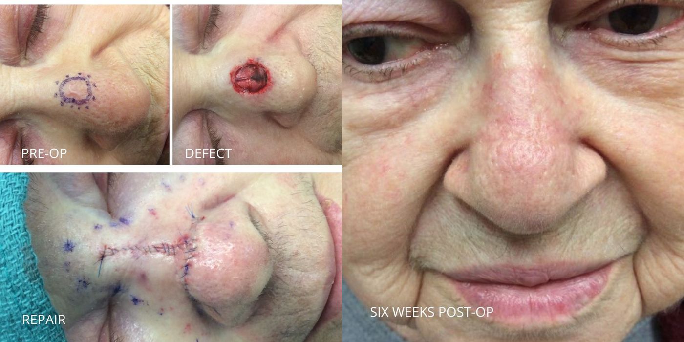 Mohs Surgery - Nose - Case 5401
