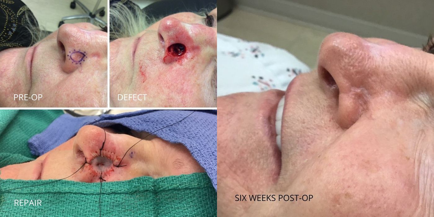 Mohs Surgery - Nose - Case 5398