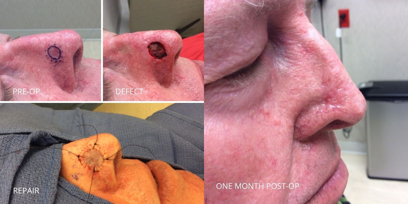 Mohs Surgery - Nose - Case 5393