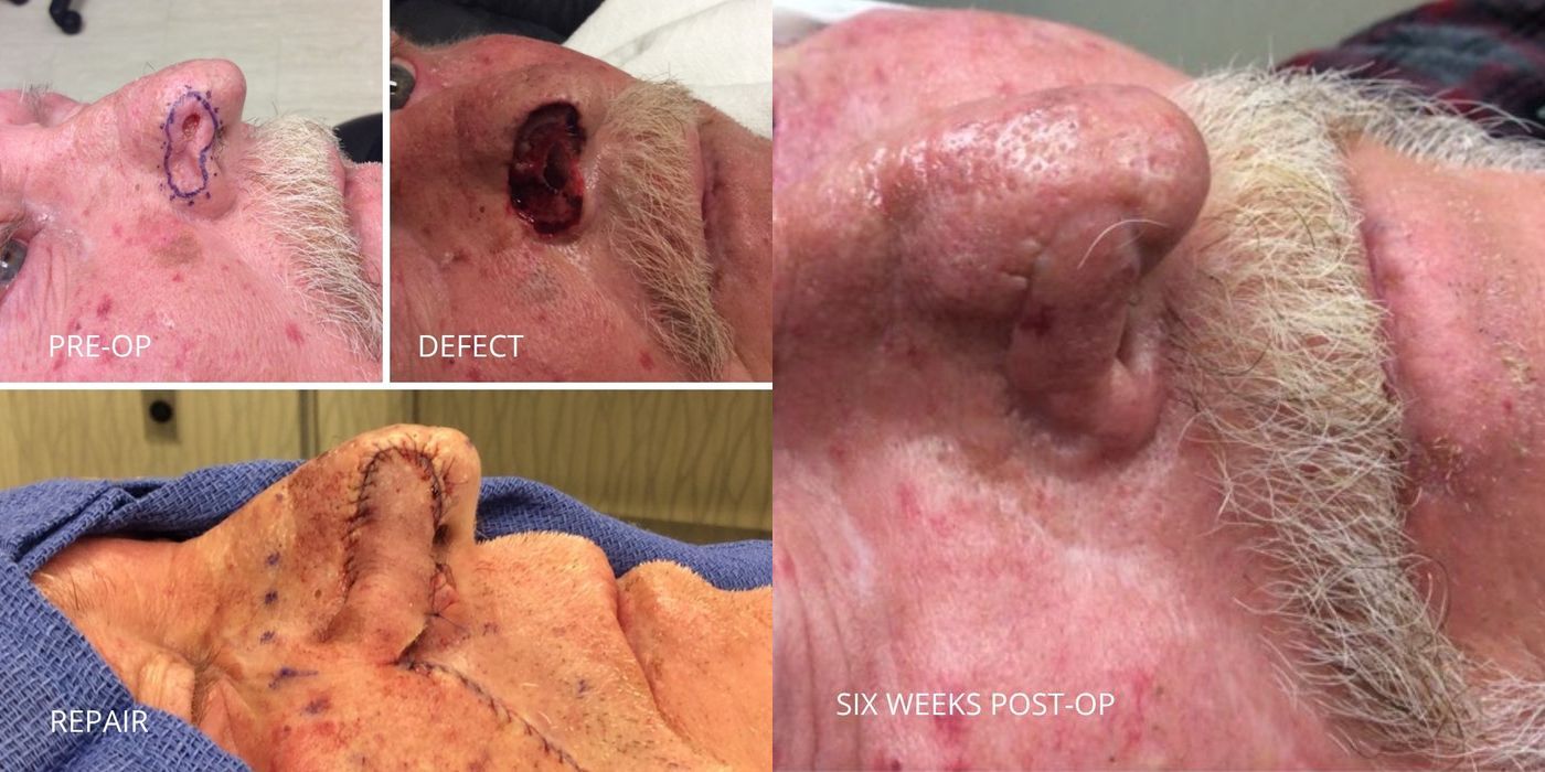Mohs Surgery - Nose - Case 5396