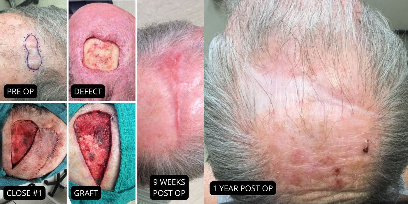 Mohs Surgery - Scalp - Case 5409