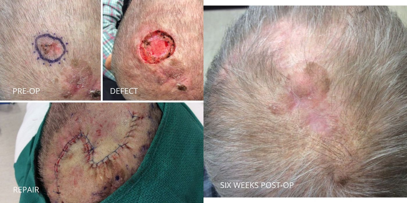 Mohs Surgery - Scalp - Case 5408