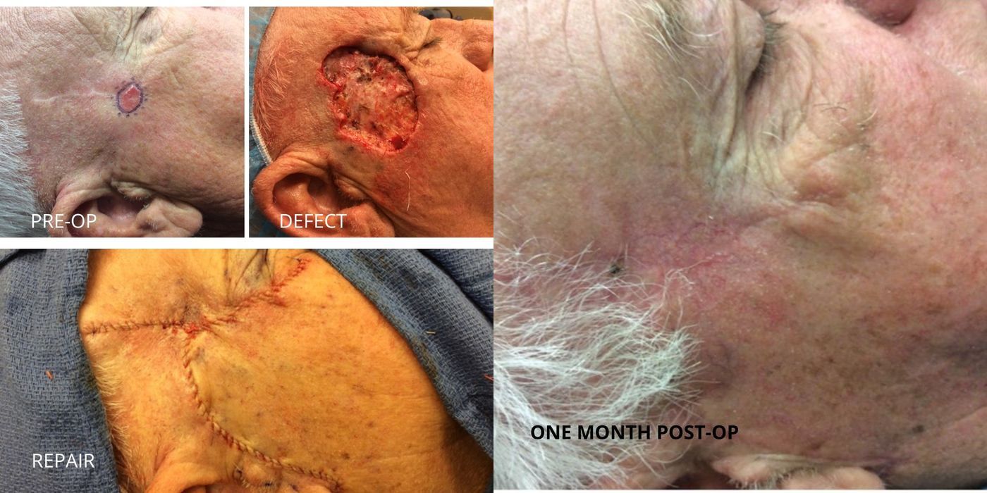 Mohs Surgery - Temple - Case 5411