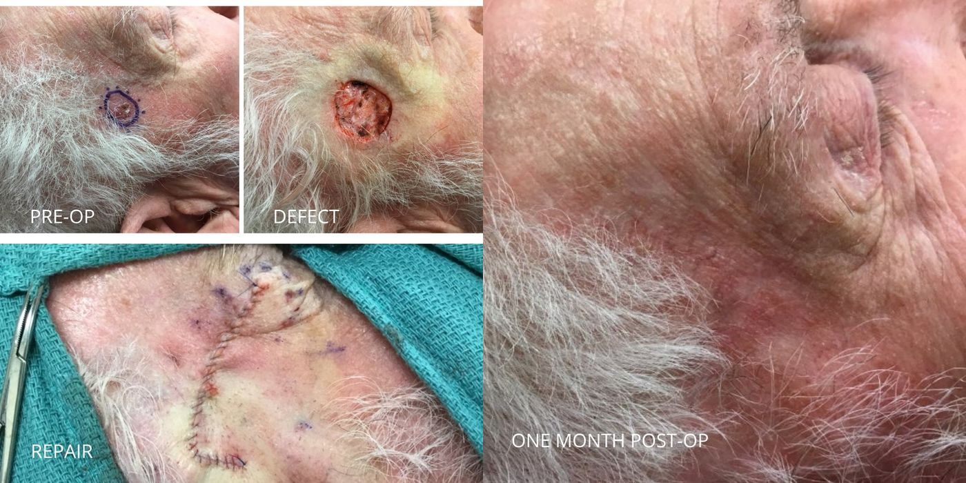 Mohs Surgery - Temple - Case 5412