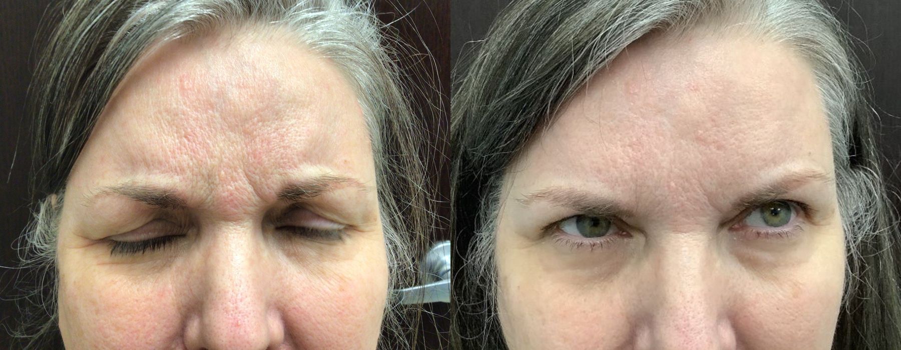 Neurotoxins - Case 5360