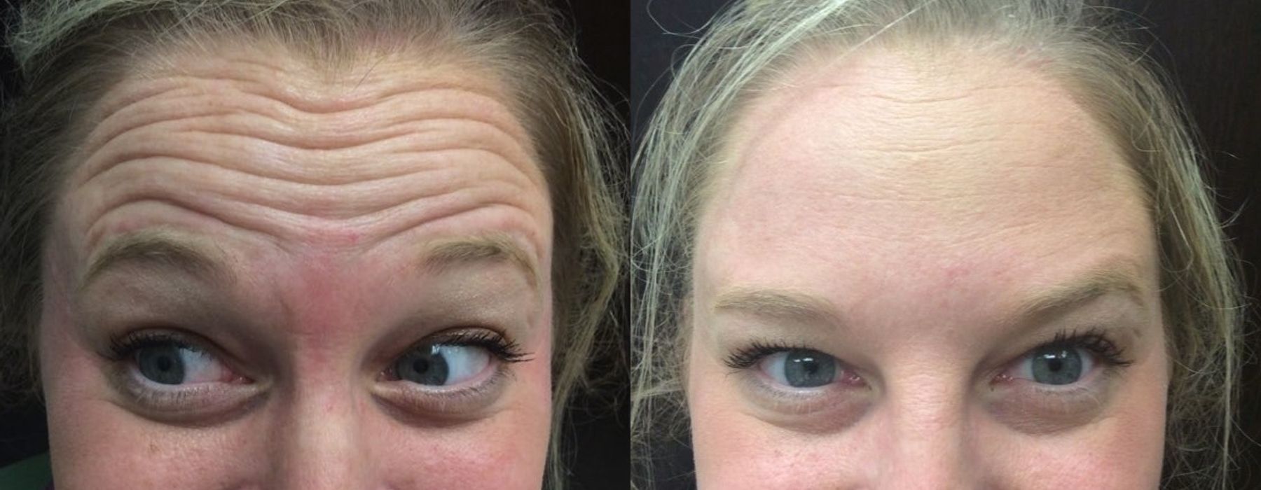 Neurotoxins - Case 5359