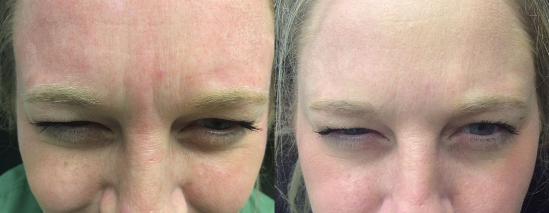 Neurotoxins - Thumbnail 2