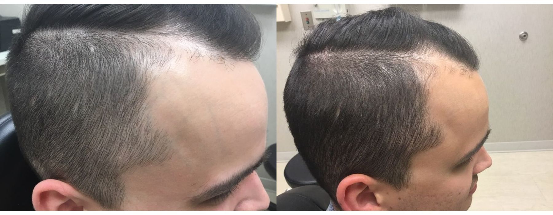 PRP Hair - Case 5299