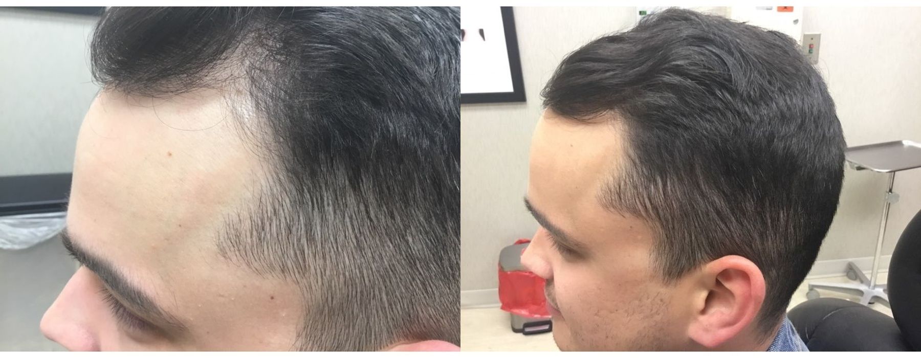 PRP Hair - Thumbnail 2