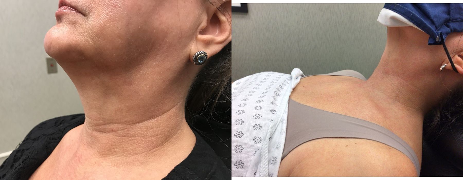 Radiesse - Case 5362