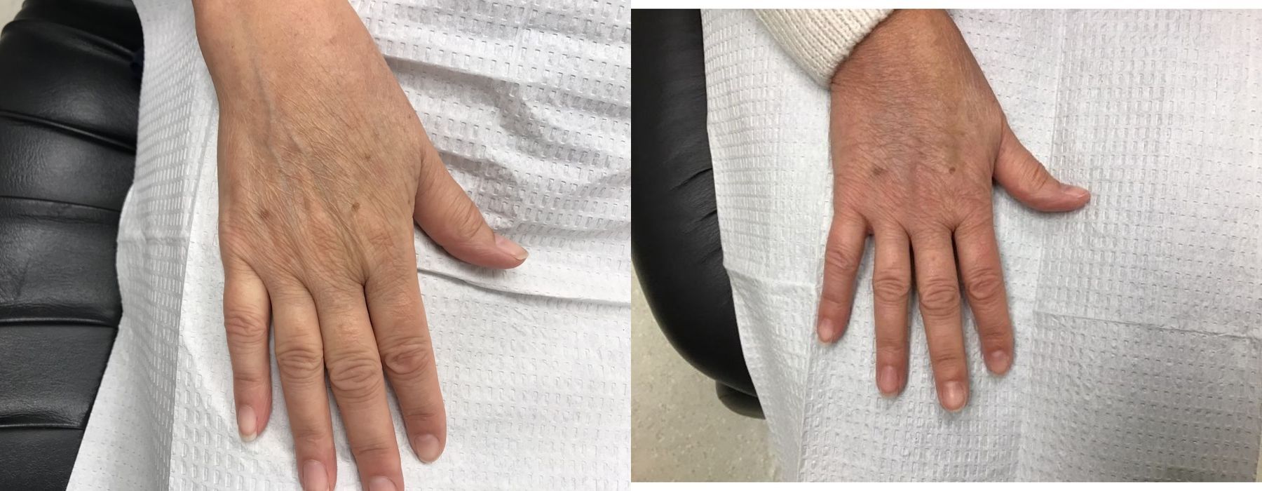 Radiesse - Case 5361