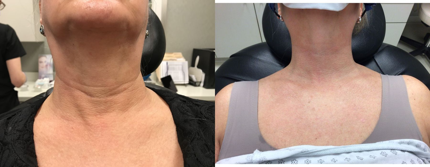 Radiesse - Thumbnail 2