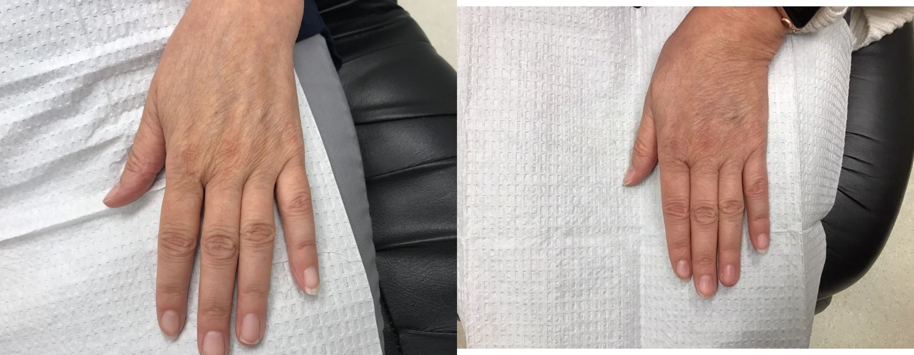 Radiesse - Thumbnail 2