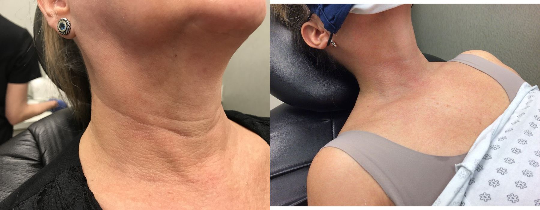 Radiesse - Thumbnail 3