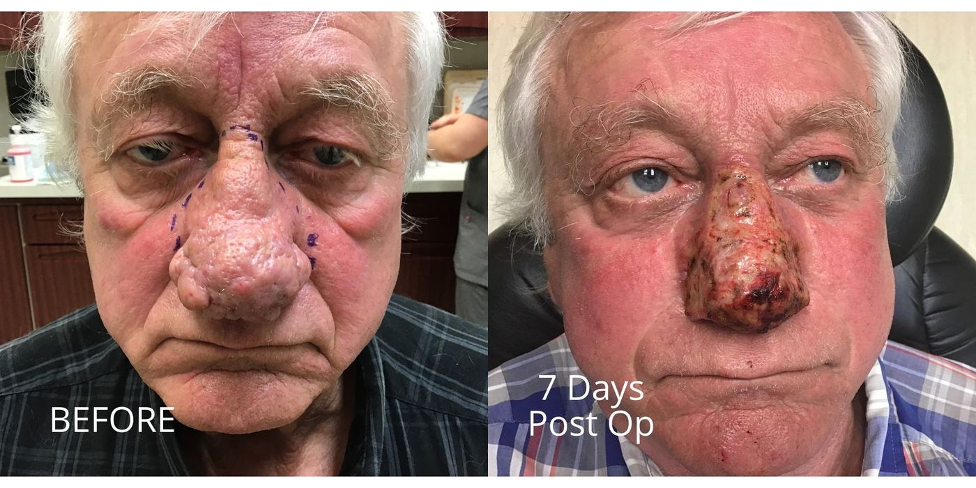 Rhinophyma - Case 5337