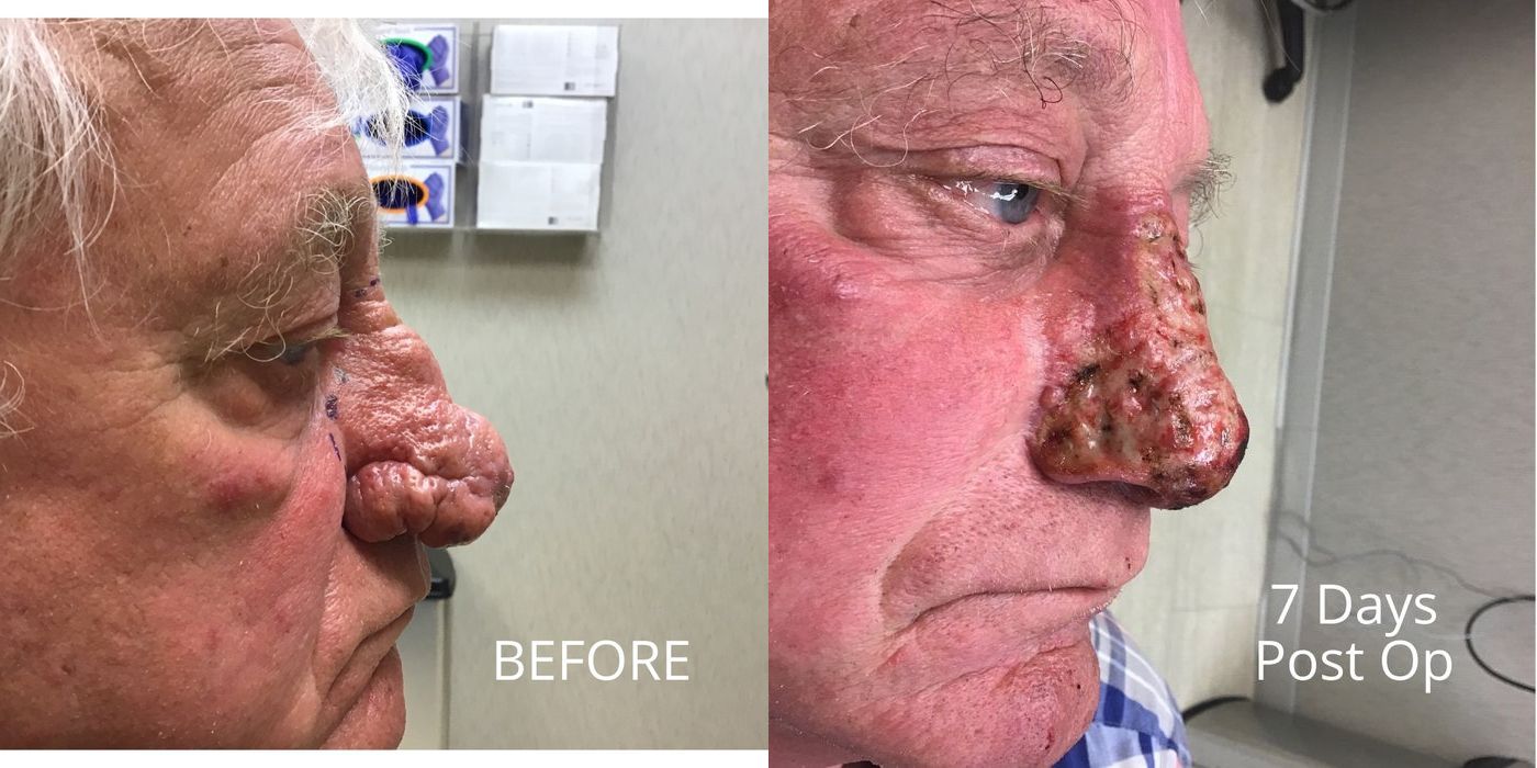 Rhinophyma - Thumbnail 4