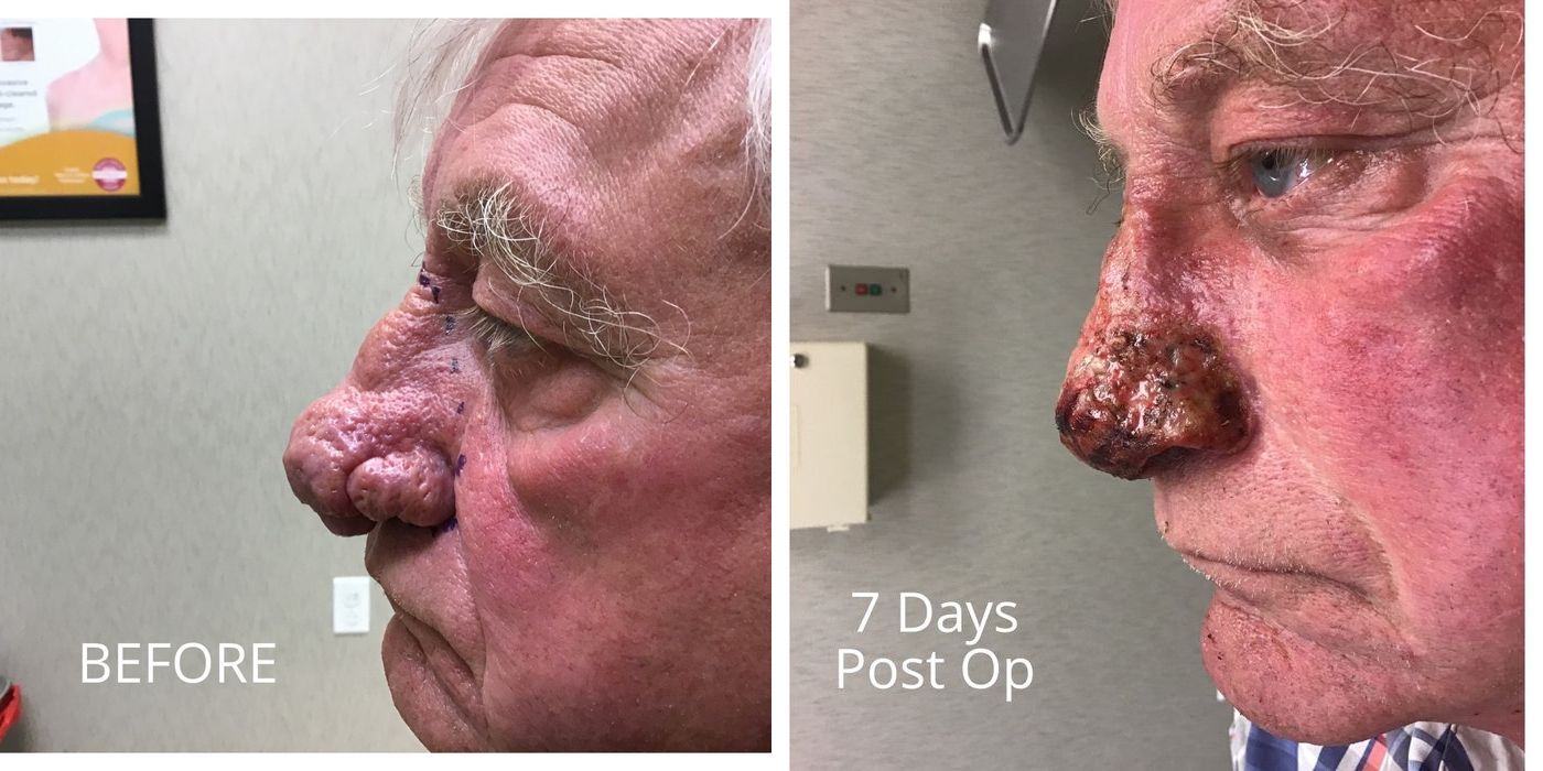 Rhinophyma - Thumbnail 3