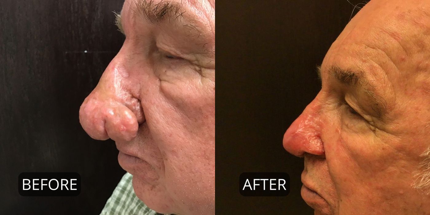 Rhinophyma - Thumbnail 4