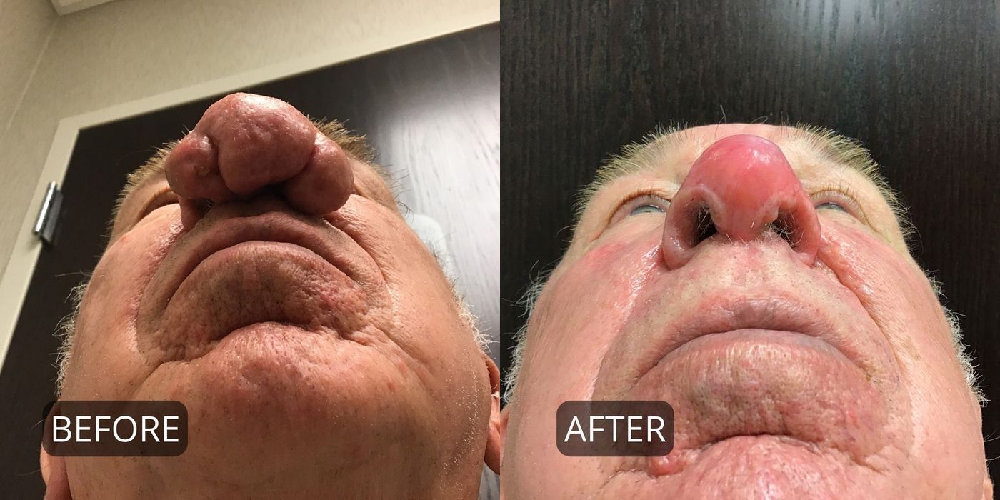 Rhinophyma - Thumbnail 2