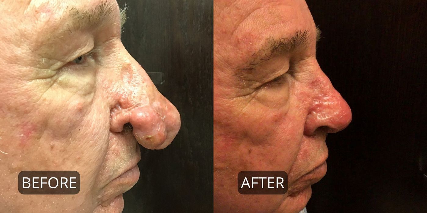 Rhinophyma - Thumbnail 3