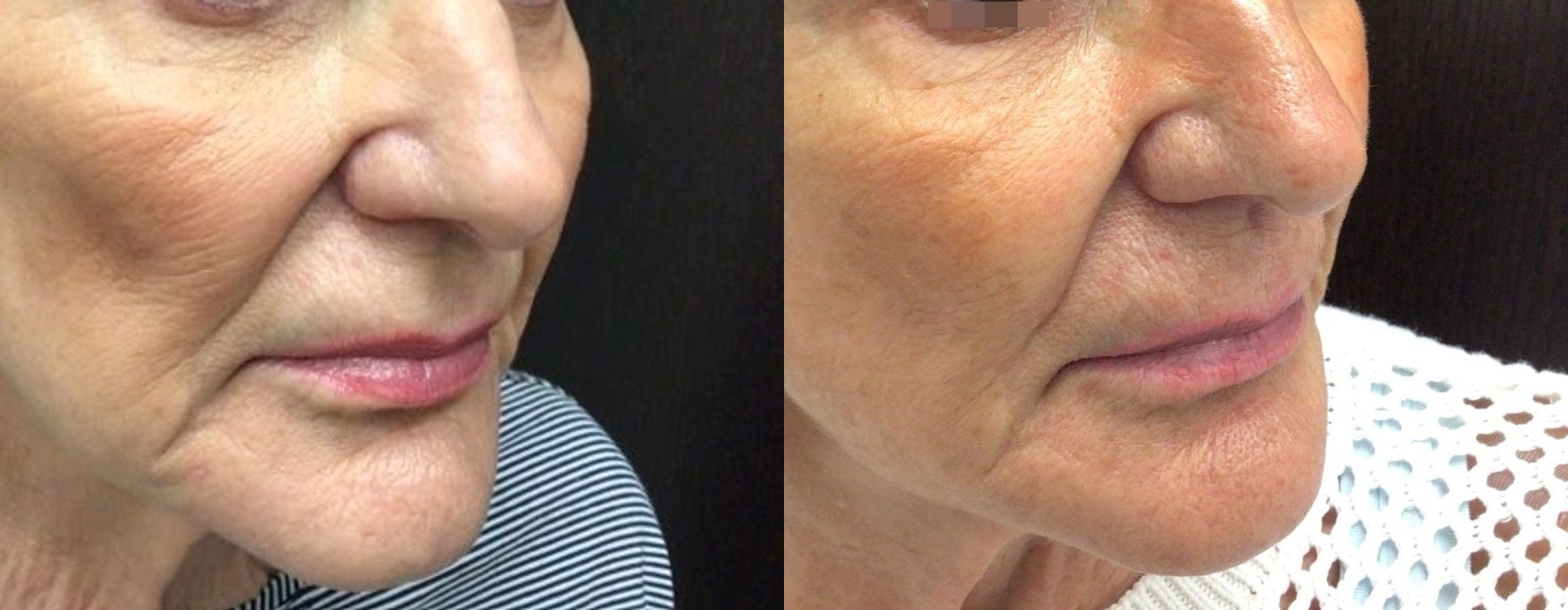 Sculptra Aesthetic - Case 5363