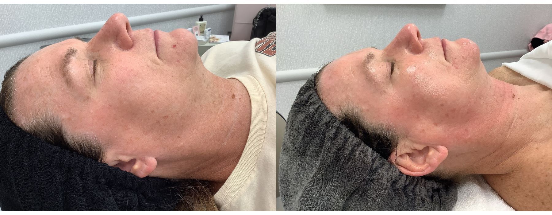 SkinPen Microneedling - Thumbnail 3