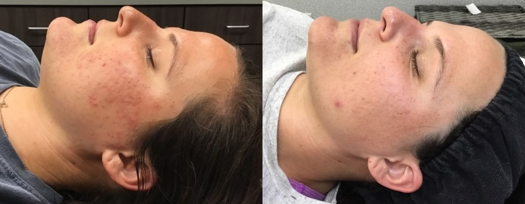 SkinPen Microneedling - Thumbnail 3