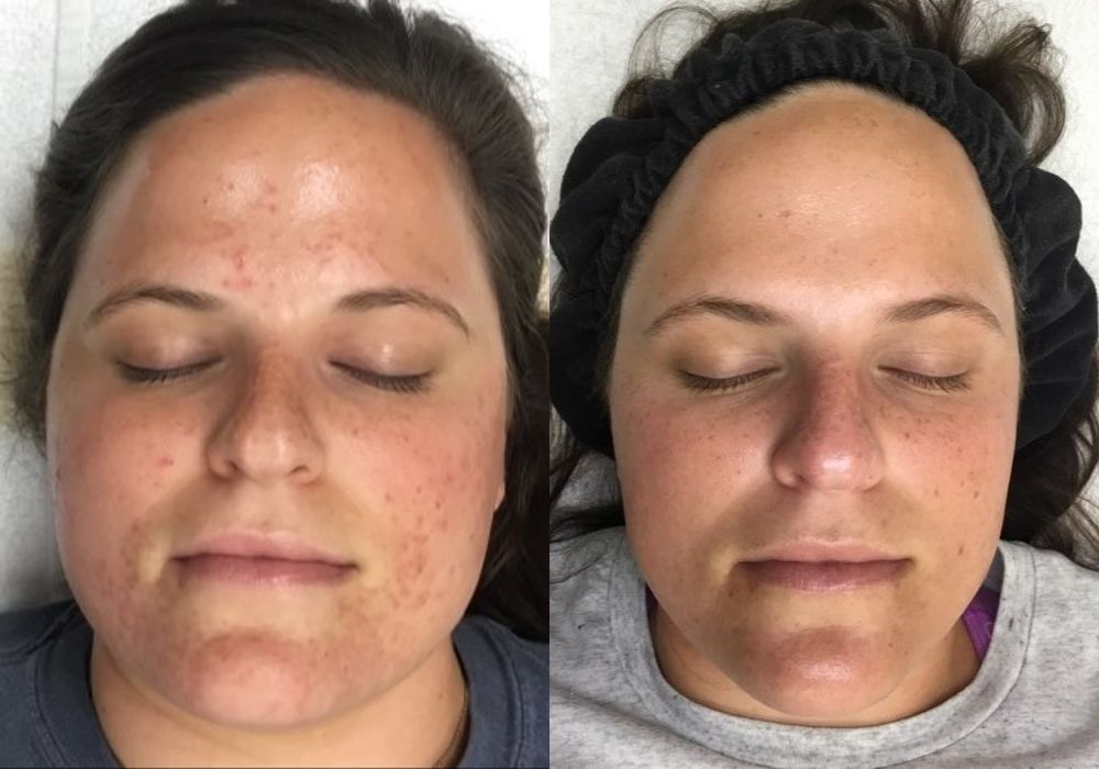 SkinPen Microneedling - Case 5339