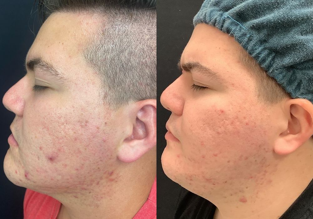 SkinPen Microneedling - Thumbnail 2