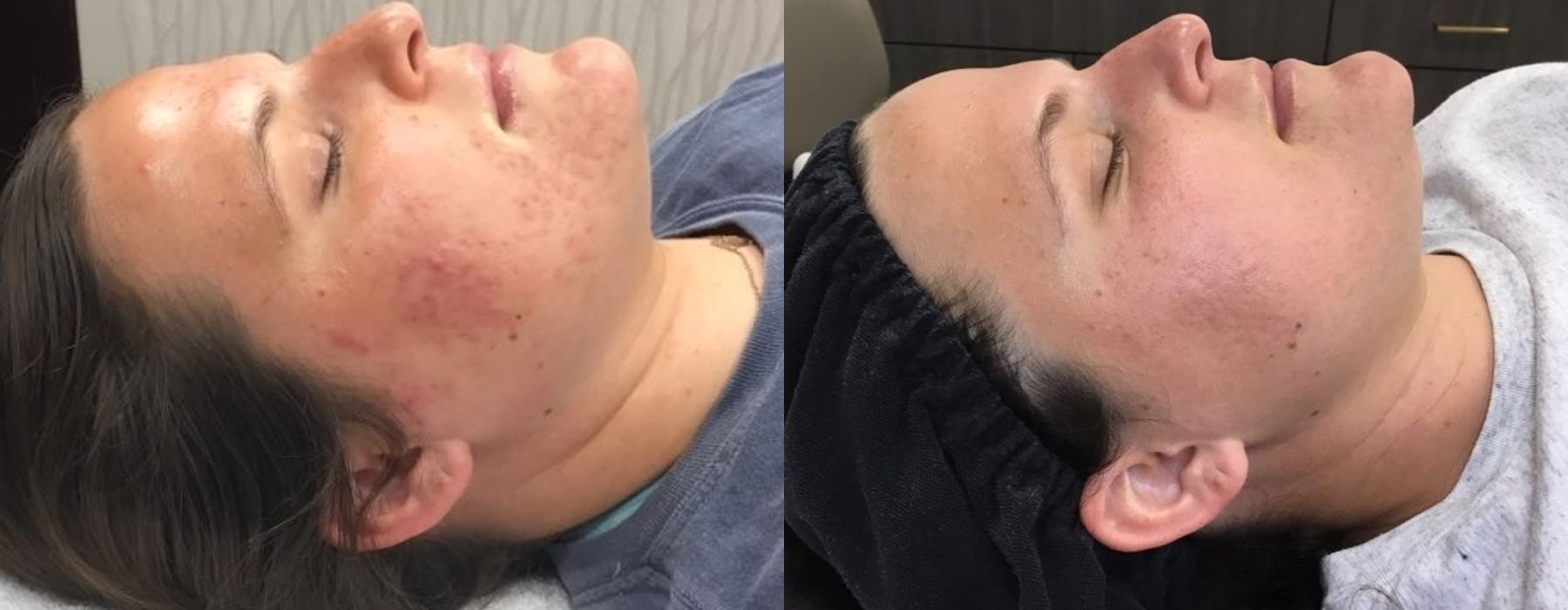 SkinPen Microneedling - Thumbnail 2