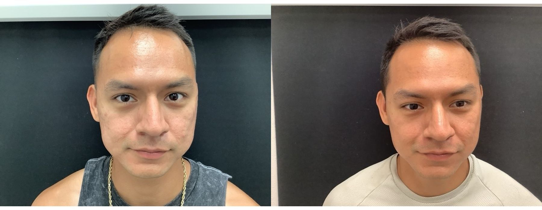 SkinPen Microneedling - Case 5341