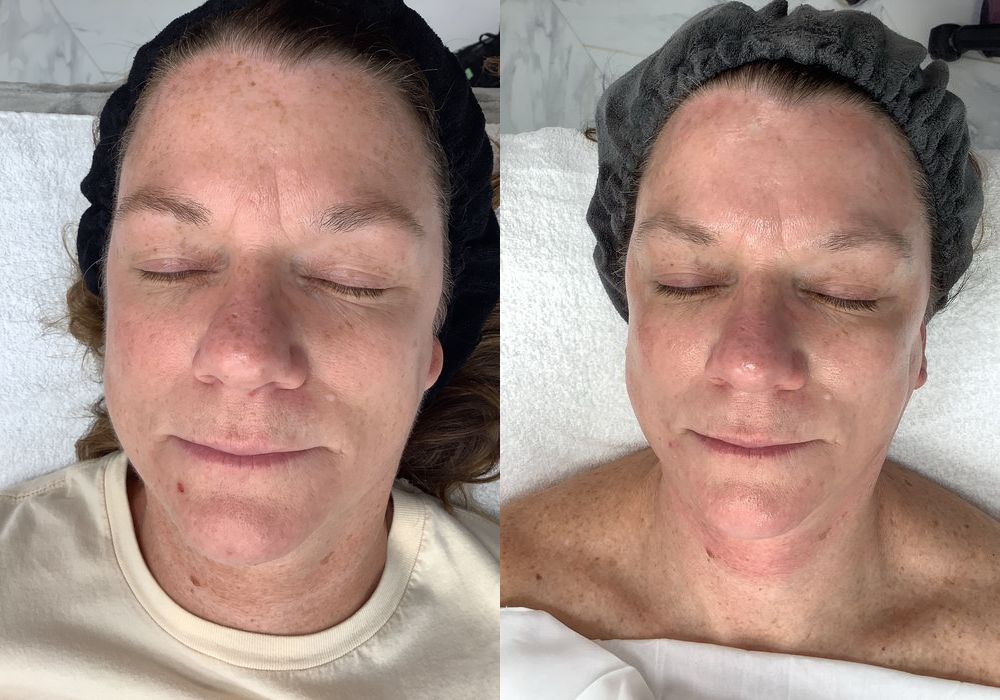 SkinPen Microneedling - Case 5342