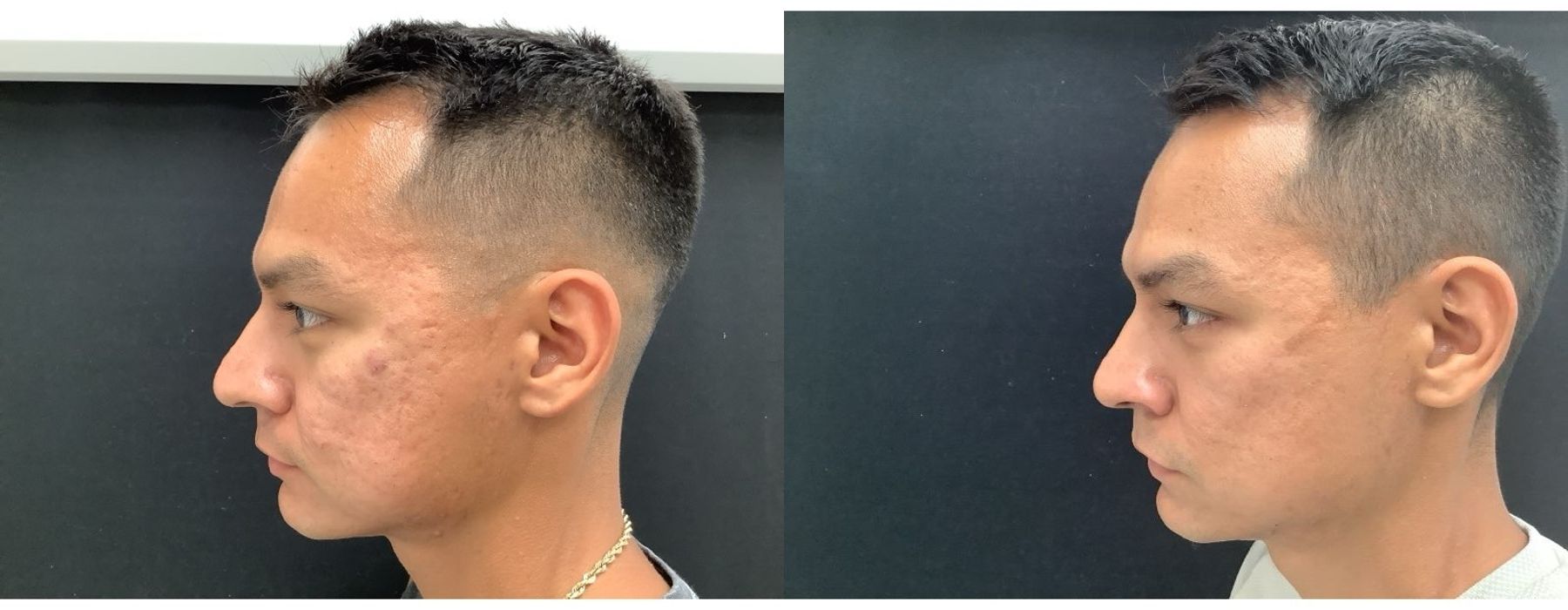 SkinPen Microneedling - Thumbnail 2