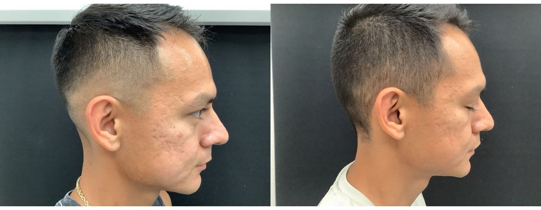 SkinPen Microneedling - Thumbnail 3