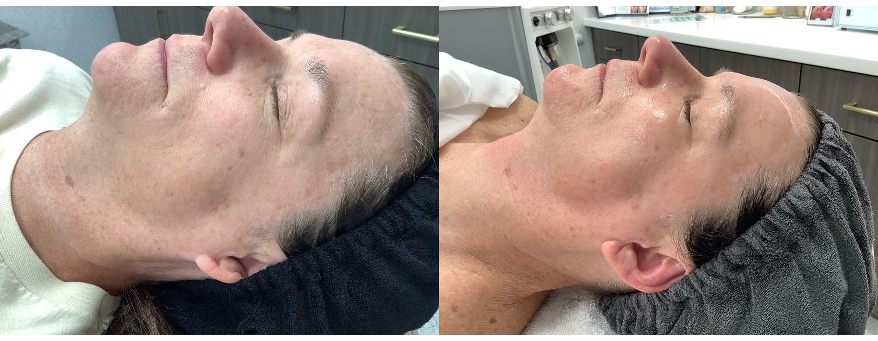 SkinPen Microneedling - Thumbnail 2