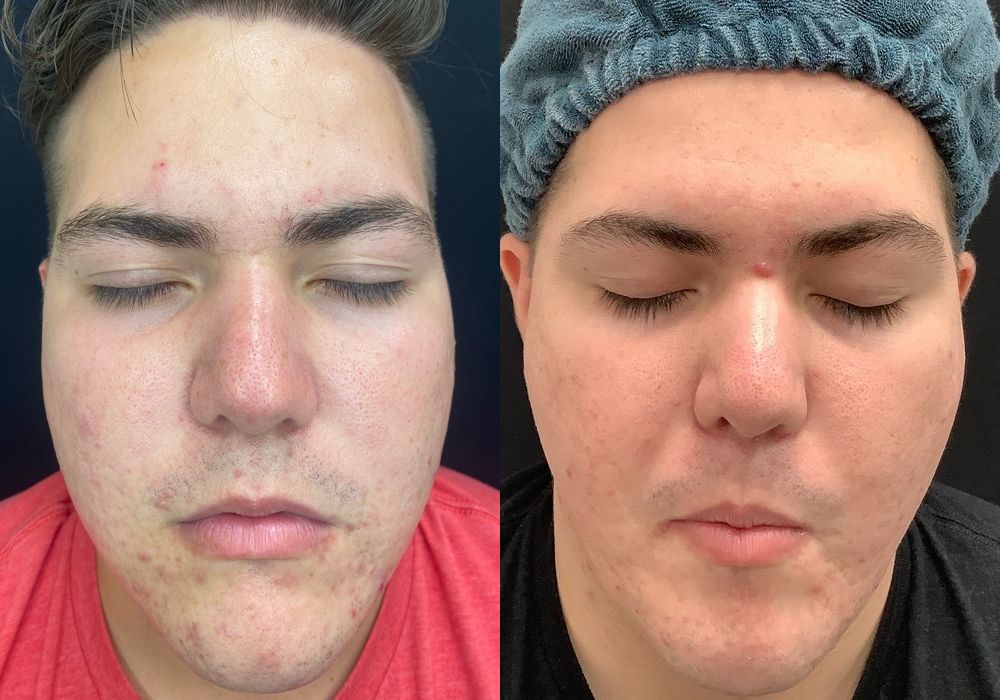 SkinPen Microneedling - Case 5340