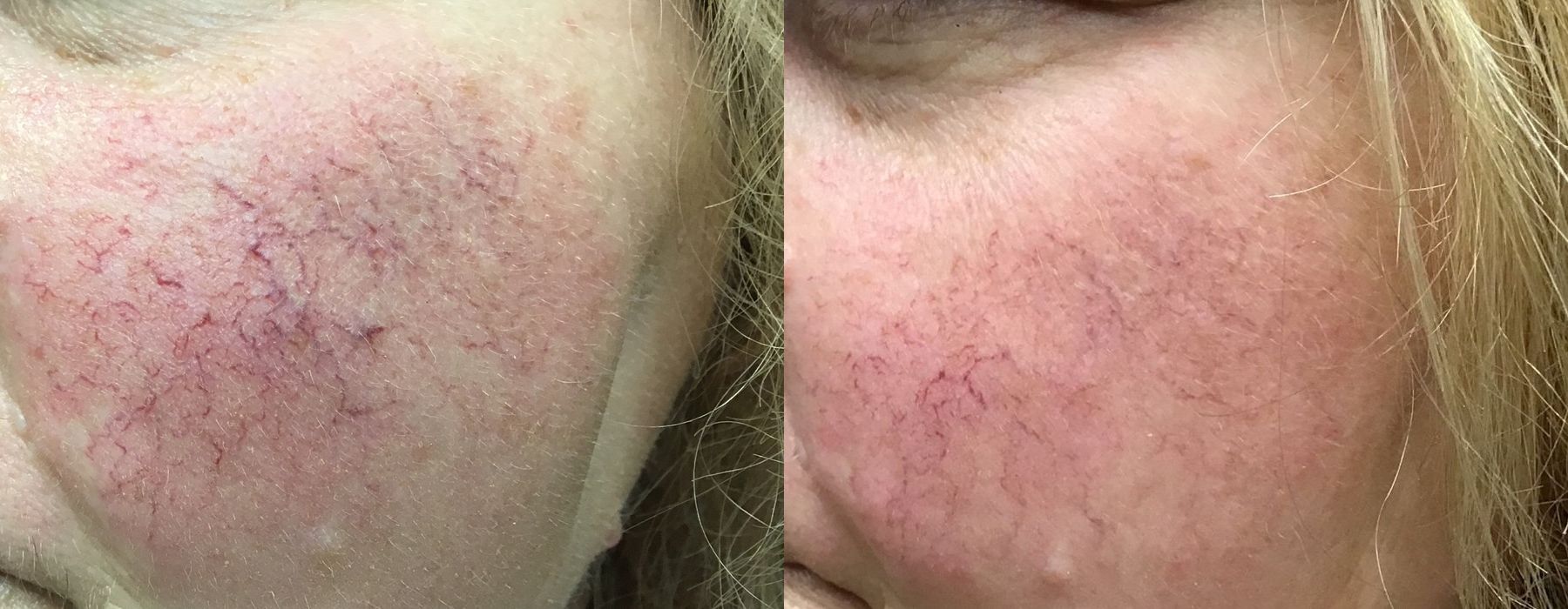 Spider Veins - Thumbnail 2