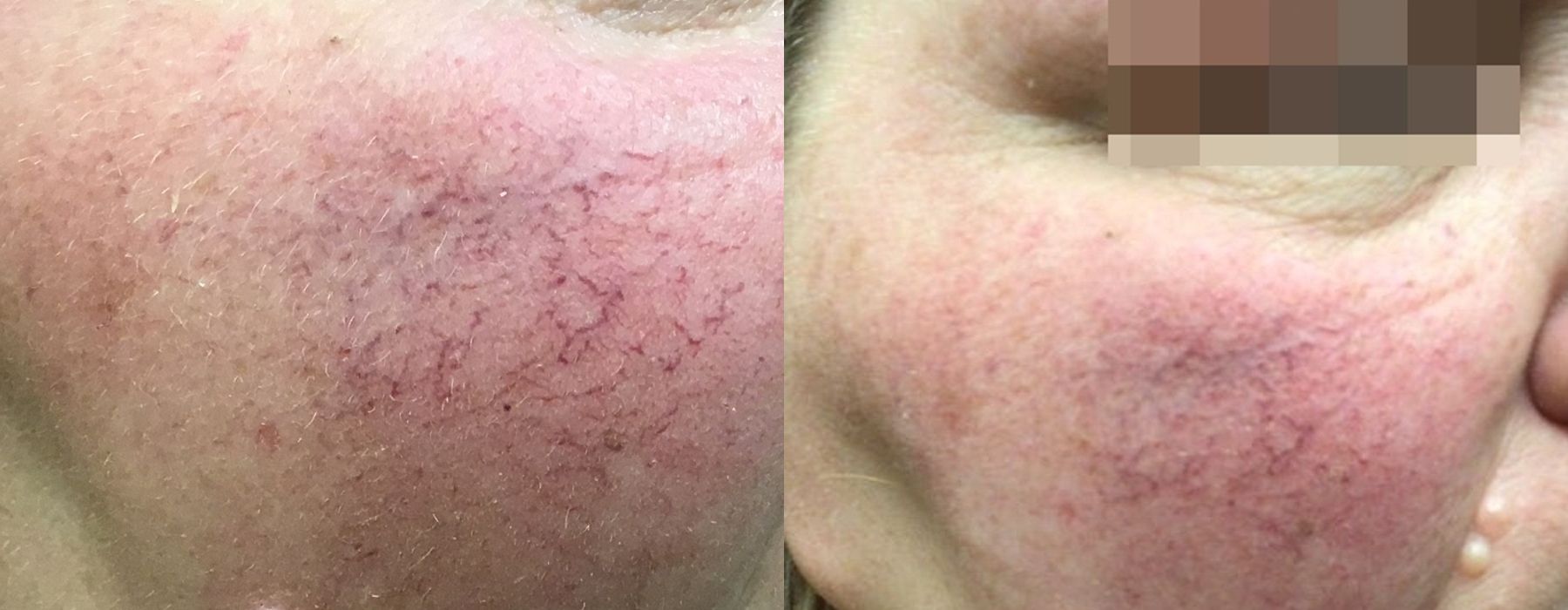 Spider Veins - Case 5343